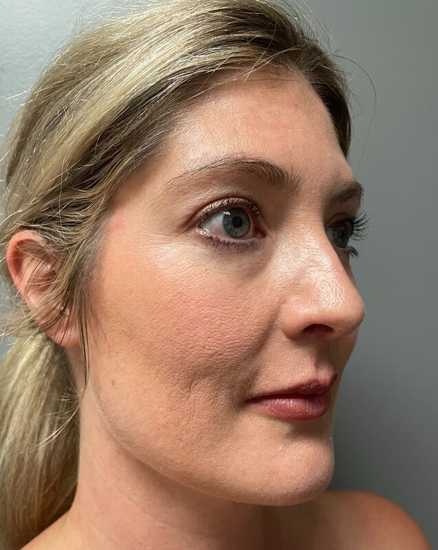 Upper Lip Lift Before & After Image